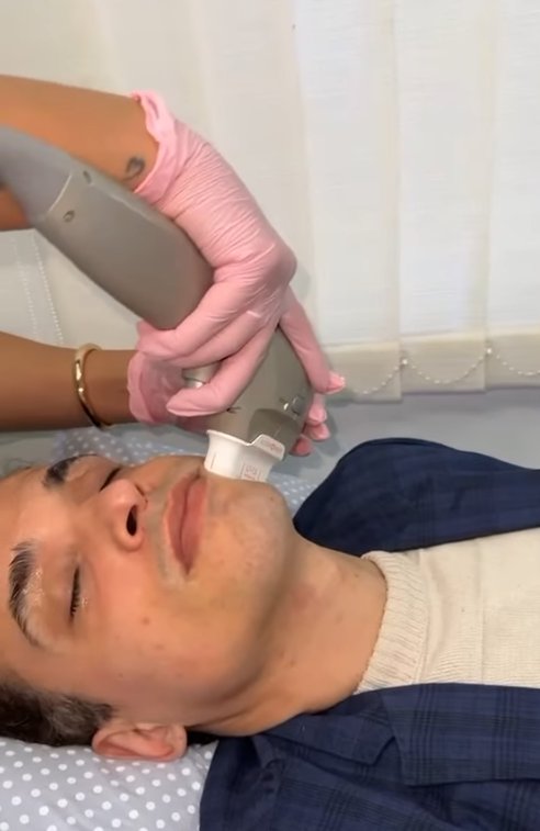 Procedimento com Laser CO₂ Fracionado na clínica da Dra. Esmaely Linhares
